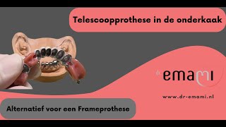 Telescoopprothese Frameprothese [upl. by Terrance]