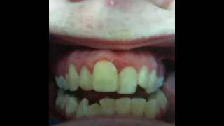 OPEN BITE  treatment with TADS and High Speed Braces TM [upl. by Lib]