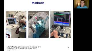 MRIgLITT thalamotomy for essential tremor  ESSFN 2021 [upl. by Nirtiac689]