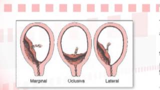 Dr Ignacio Pérez Tomasone ¿Qué es la placenta previa [upl. by Quintilla]