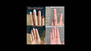 Brachydactyly type D toethumbs clubbed thumbs stubby thumbs brachydactyly [upl. by Eneloj53]