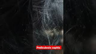 Pediculosis extreme  very severe head lice infestation shorts [upl. by Dianthe35]