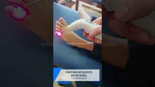 Tratamento conservador  Laserterapia  Fratura no quinto metatarso [upl. by Adnuhsat]