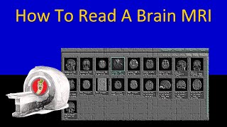 How To Read A Brain MRI  Neuroradiology Made Easy Maybe [upl. by Einnok732]