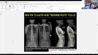 What Is the Target for Optimal Sagittal Alignment and How Do We Achieve It  Lawrence G Lenke MD [upl. by Clemence]