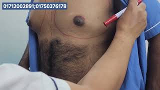 পুরুষের বড় স্তনের চিকিৎসা। Gynecomastia Surgery in Bangladesh [upl. by Ahsoet425]