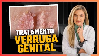 Tratamento para VERRUGA GENITAL [upl. by Siloa]