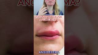 Fosinopril causa angioedema shorts [upl. by Tai]