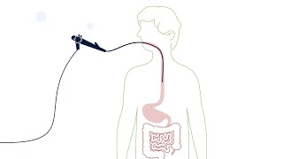 What is an Esophagogastroduodenoscopy EGD [upl. by Alastair]