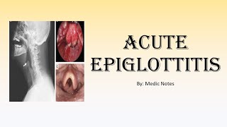 Acute epiglottitis  EMERGENCY condition causes clinical features investigation treatment [upl. by Hackney]