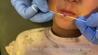 How to Replace Orthodontic Separators [upl. by Reyem]