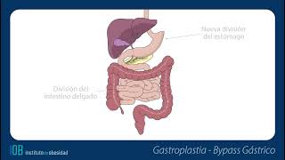 Reintervenciones  Gastroplastia a ByPass [upl. by Maurene]