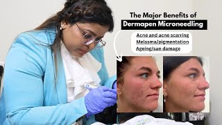 Dermapen microneedling can help reduce the Ageing fine lines and wrinkles or acne scars [upl. by Lias551]