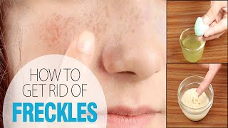 How to Get Rid of Freckles Fast  Home Remedies for Freckles Treatment  Dark spots Removal [upl. by Arimihc241]