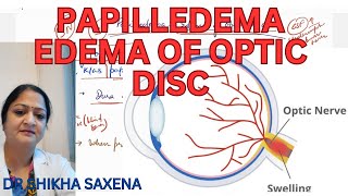 Papilliedema Edema of optic disc high CSF Pressure [upl. by Anelej]