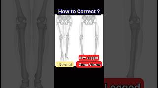 Bow Legs Correction Genu Varum Exercise [upl. by O'Reilly]