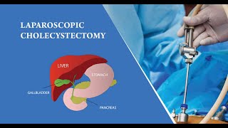 Cholecystectomy surgery Laparoscopic [upl. by Nagle]