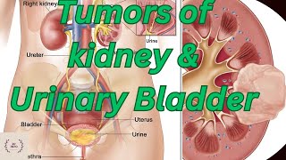 Tumors of Kidney amp Urinary BladderCancer of Kidney and Urinary BladderAblation amp Nephrectomy video [upl. by Anawahs679]