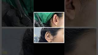 Otoplasty surgery in Pakistan lahore by doctor Saleem otoplasty otoplastysurgery [upl. by Wiggins]