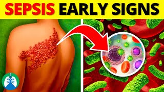 Top 10 Early Warning Signs of Sepsis  NEVER Ignore THIS [upl. by Nahtahoj]