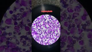 Leukocytosis [upl. by Niassuh]