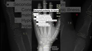 Delayed puberty in boys [upl. by Madelin212]