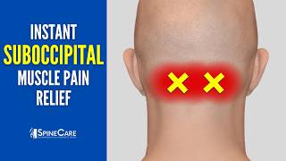 How to Fix Suboccipital Pain in 30 SECONDS Base of Skull Pain Relief [upl. by Haerdna]