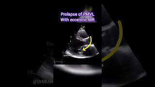 Prolapse of Posterior Mitral Valve Leaflet with Eccentric MR echocardiogram echocardiography [upl. by Bloomer844]