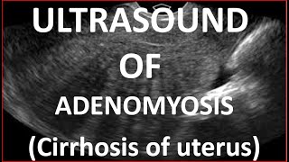 Ultrasound of Adenomyosis [upl. by Marcelia]