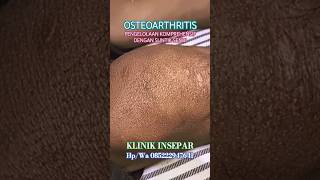 OSTEOARTHRITIS  syarhan ruralhealthcare [upl. by Amara]