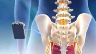 Overview of Sacral Nerve Stimulation for Urinary Control [upl. by Ylrahc]