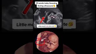 25 weeks baby sneezing during ultrasound😘😘viralvideo trending viralshorts [upl. by Naivaj]