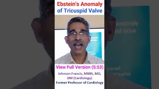 Ebsteins Anomaly of Tricuspid Valve [upl. by Harimas434]