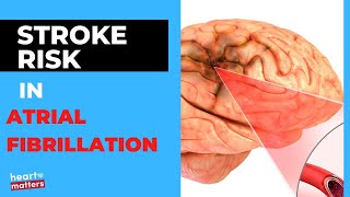 Atrial Fibrillation AF and the Risk of Stroke [upl. by Gnuy]