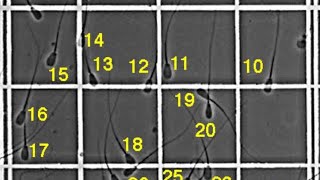 Sperms counting by Neubauer chamber  Sperms counting formula [upl. by Addie764]