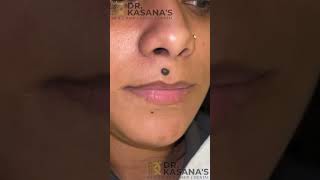 Mole Removal EXPERT Shares Top Secrets  DrLalit Kasanas [upl. by Zacherie]