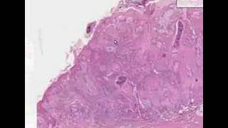 Histopathology Skin Squamous cell carcinoma [upl. by Nadean]