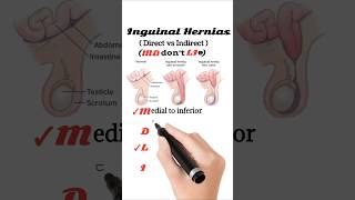 Direct vs Indirect inguinal hernia [upl. by Zsa168]