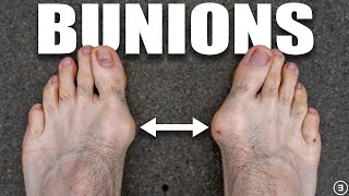 Bunions  Hallux Valgus Diagnosis Exercises Treatment [upl. by Eelac]