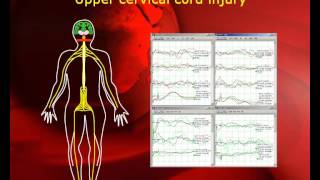 quotPatient Transparentquot Intraoperative Neurophysiological Monitoring in MISS [upl. by Estell]