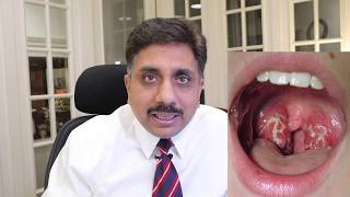 Homeopathic Medicines for Tonsillitis [upl. by Anatol]