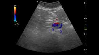 Aortic Dissection  QMH AED Ultrasound Casebook 201409 Video 6 [upl. by Torr]