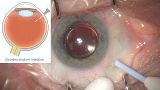 Ozurdex Implant Intravitreal Eye injection for Treatment of Retinal Oedema and Inflammation [upl. by Haleelahk]