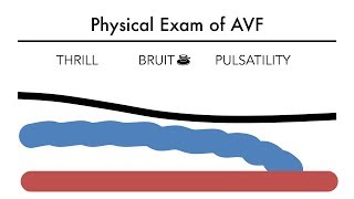 Hemodialysis Access 101 03  Physical Exam of AVF [upl. by Felicidad273]