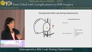 Intraoperative Bile Leak During Hepatectomy [upl. by Imhsar]