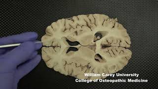 Horizontal slices of human forebrain neuroanatomy forebrain internal capsule caudate nucleus [upl. by Riccio]