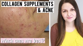 Best Collagen Supplements for Acne Prone Skin  Supplements for Clear Skin [upl. by Greggory119]