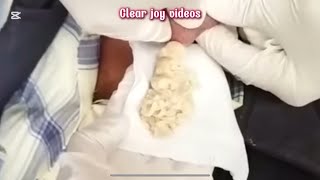 Big Cystic Acne Blackheads Extraction Blackheads amp Milia Whiteheads Removal Pimple Popping [upl. by Jerome]