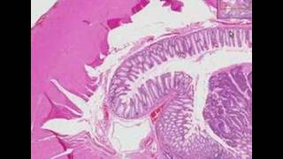 Histopathology Colon Adenocarcinoma [upl. by Ringe]