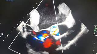 Thrombus in Transient  LAA Thrombus in Severe MS patient [upl. by Allina61]